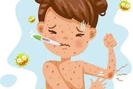 ВЕТРЯНАЯ ОСПА И МЕРЫ ПРОФИЛАКТИКИ